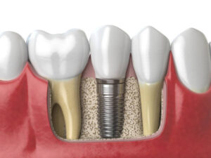 dental implants Manhattan NYC
