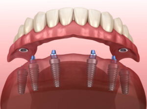 Dental implants nyc