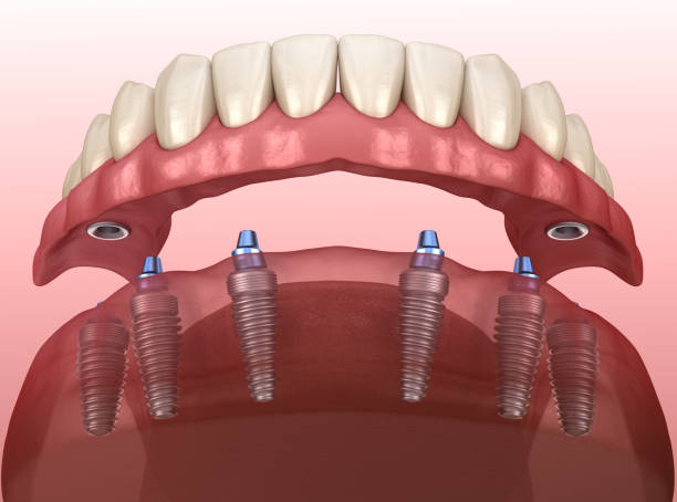 Dental implants nyc