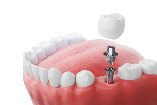 Dental implants nyc