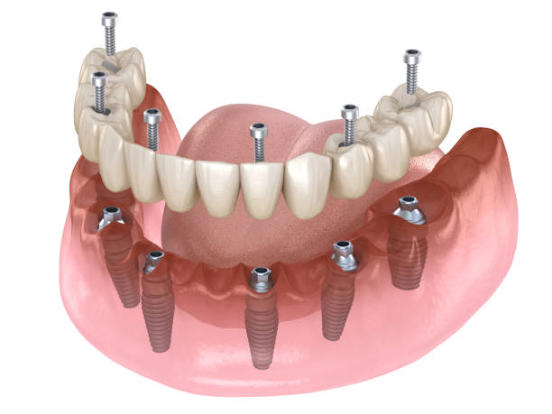 Dental implants nyc