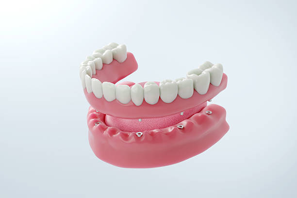 full arch dental implants in Manhattan