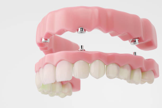 Full Arch Dental Implants in Manhattan