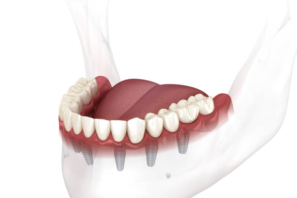 Fixed Full Arch Dental Implants