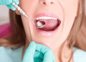 impacted canine removal