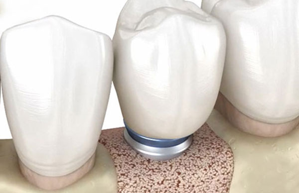 bone grafting under an implant
