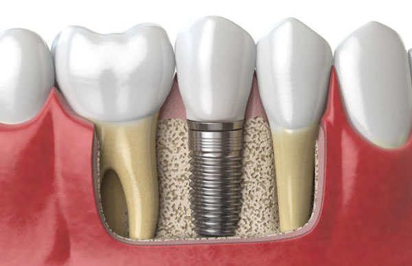 internal view of a dental implant in a jaw bone